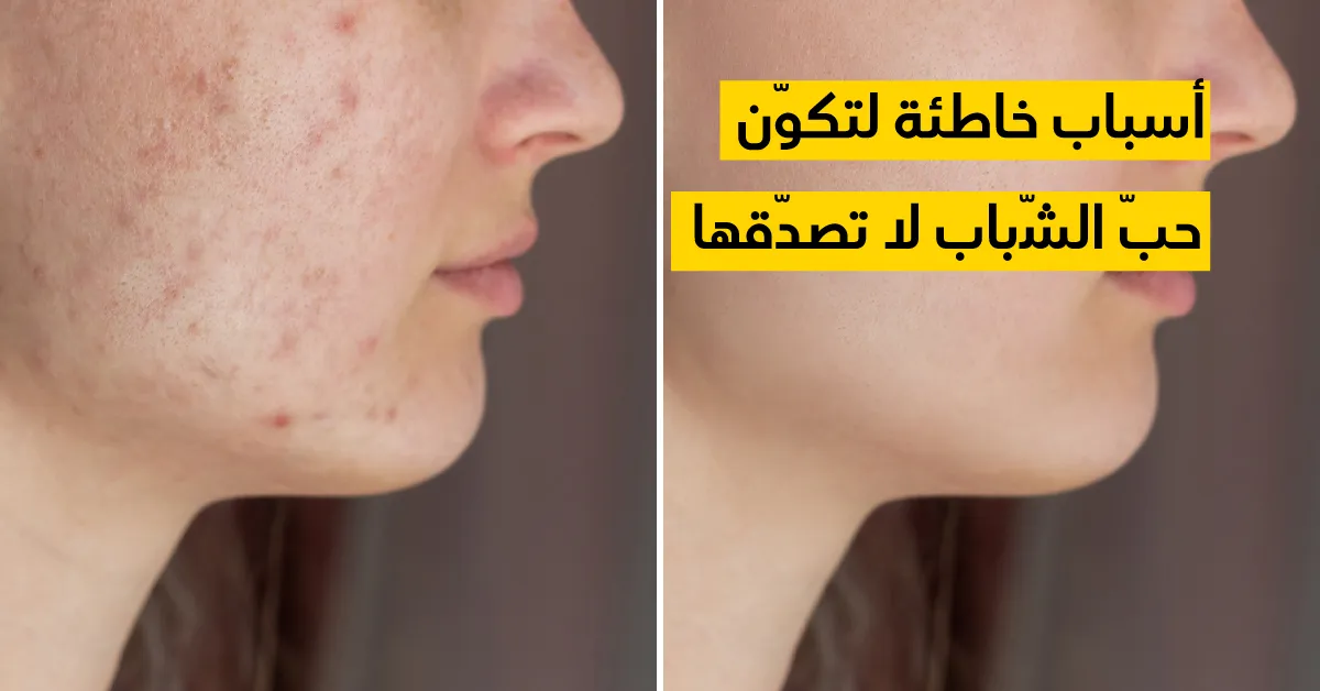 أسباب خاطئة لتكوّن حبّ الشّباب لا تصدّقها